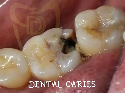 Dental Caries : Unveiling the Truth About Tooth Decay - DEV DONTICS