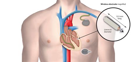 Revolutionary Leadless Pacemaker From Cambridge Consultants - pacemaker en icd