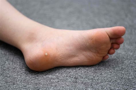 Plantar Warts: Symptoms, Causes, Treatment and More