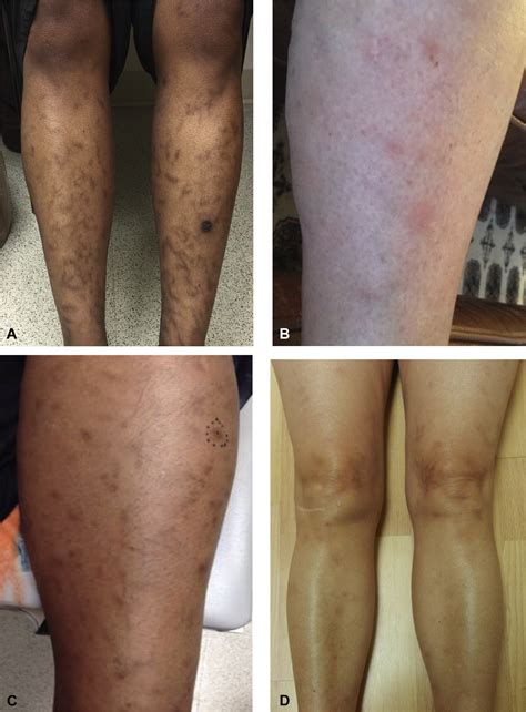 Macular lymphocytic arteritis: Clinical-pathologic correlation of a rare vasculitis - JAAD Case ...