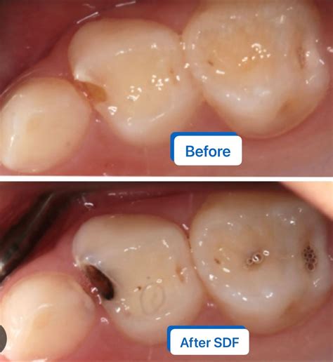 How to prevent dental caries with SDF | Dental Hygiene Practice of Jan ...