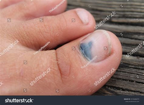 557 Bruised toenails Images, Stock Photos & Vectors | Shutterstock