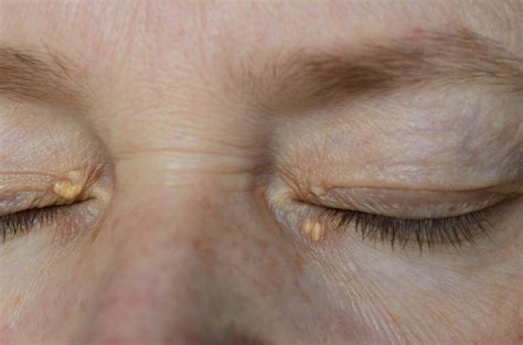 How To Control Xanthelasma: Managing Cholesterol Deposits Safely