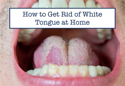 How to Get Rid of White Tongue at Home – B.WEISS Health