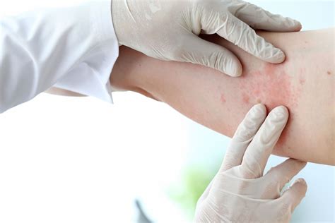 Understanding Hives: Common Causes and Triggers - Dermatologist Singapore | Skin Specialist ...