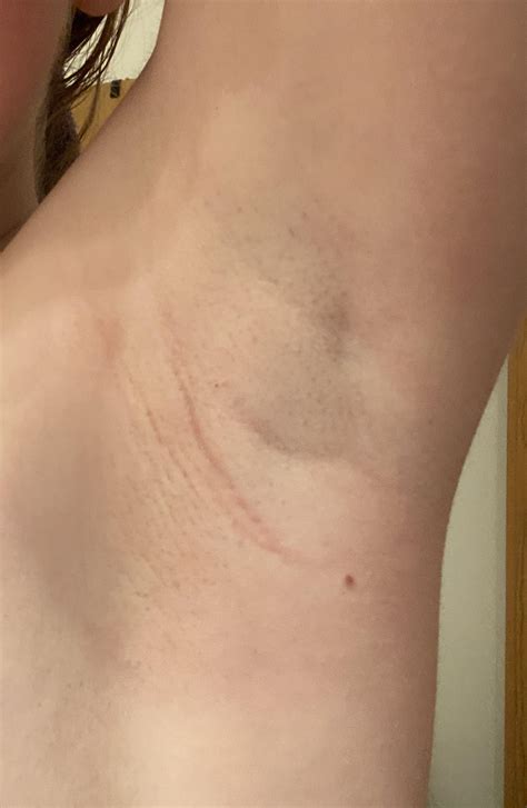 {25 F} I have this red line in one armpit and it’s can be sore/itchy. If I scratch, it gets even ...
