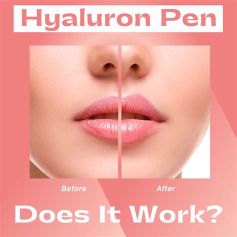 Hyaluronic Lip Filler Pen at Brianna Gellatly blog