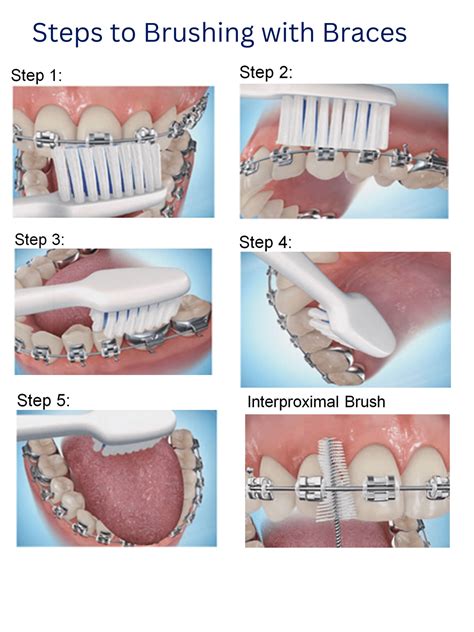 Brushing with Braces — Moore Orthodontics Affordable Orthodontist Lake ...