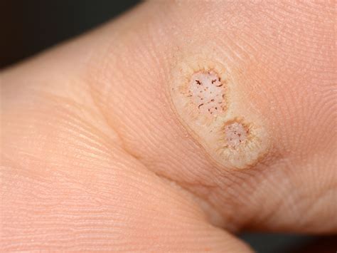 Types Of Warts On Sole Of Feet In Myanmar Agency In Singapore - Infoupdate.org