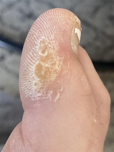 Are these things on my toes warts or calluses? I had treatments done at the derm for the warts ...