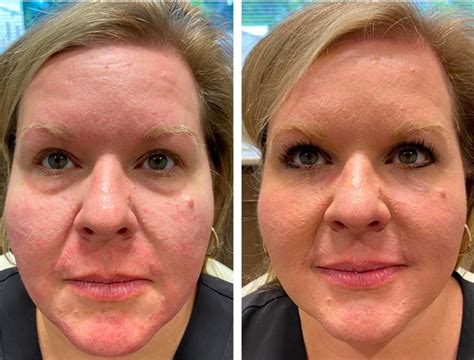 How To Fill In Sunken Under Eyes at Tawny Dunn blog