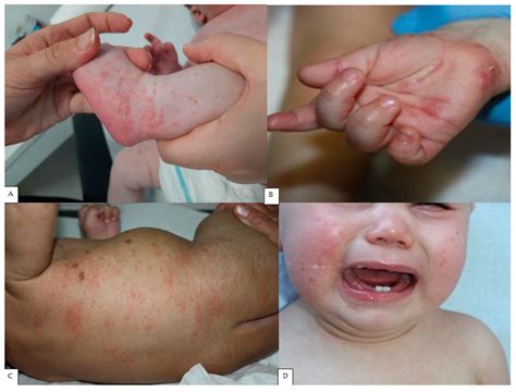 Scabies in Infants: Series of 51 Cases