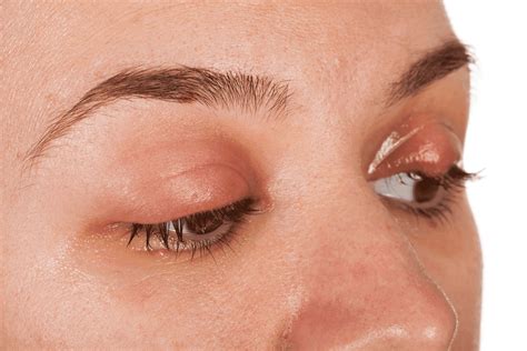 Puffy or Swollen Eyelid? Here's What It Could Mean - Doctronic