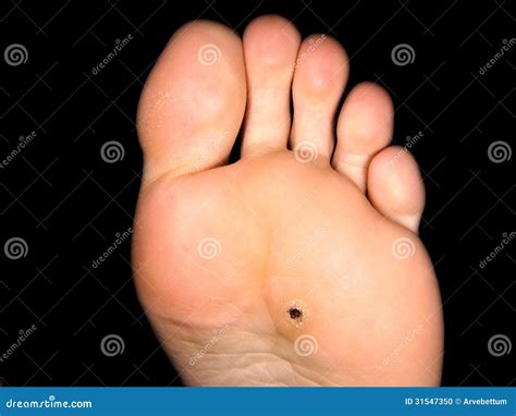 Hard Black Spot On Foot Factory Sale | emergencydentistry.com