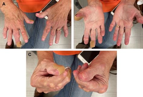 Management of Gout in the Hand and Wrist - Orthopedic Clinics