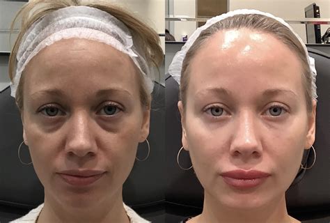 Dermal Fillers (Juvéderm®) for Elk Grove, Folsom, Roseville, & Sacramento, CA | Destination ...