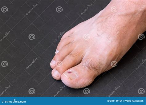 Small Purple Bruise Under Toenail on Black Background Close-up Stock Photo - Image of small ...
