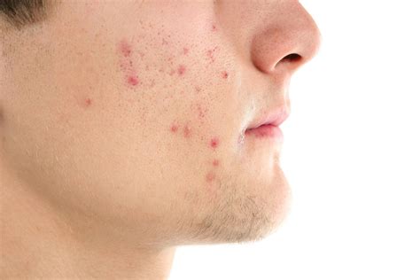 Can Stress Cause Acne?
