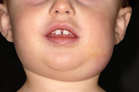 Mumps - Children's Health Issues - Merck Manual Consumer Version