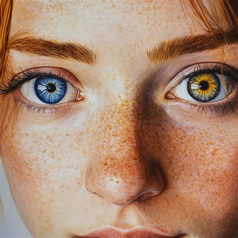 Heterochromia: Causes, Types, Information, Risks & more