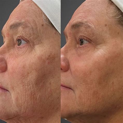 BroadBand Light Therapy - Clarity Medical Aesthetics