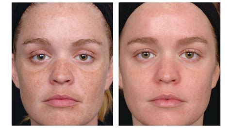 Tretinoin Before And After
