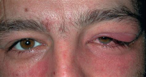 Orbital Infection and Inflammation - Clinical Tree