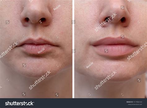 572 Before after lip fillers Images, Stock Photos & Vectors | Shutterstock