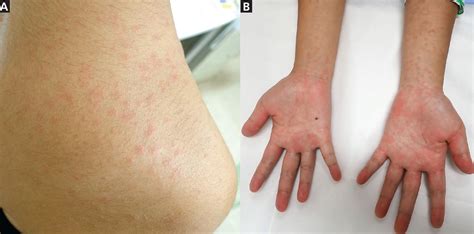 Amoxicillin rash in infectious mononucleosis | Cleveland Clinic Journal ...