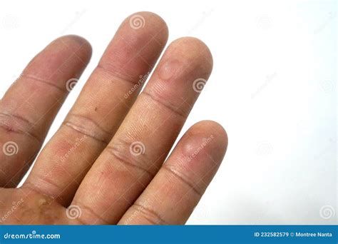 Blisters on the Tip of the Ring Finger and Little Finger Stock Image ...