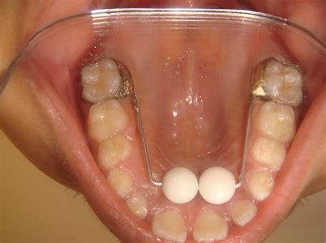Thumb sucking or finger sucking causes & how to stop sucking habit
