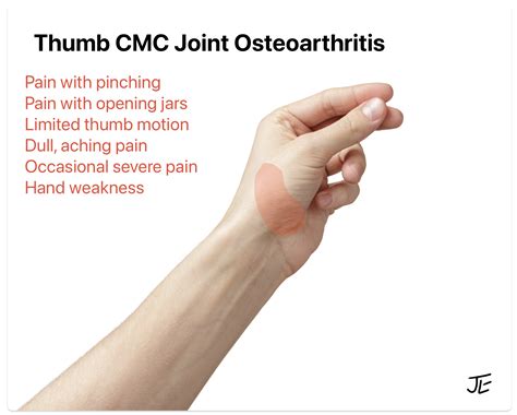 What is the Best Thumb Arthritis Surgery? - John Erickson, MD