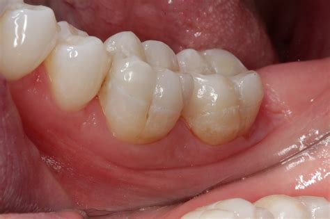 Cavity Side Of Molar
