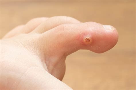 Warts on Your Feet? Symptoms & Causes of Plantar Warts - Foot and Ankle ...