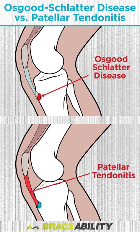Osgood Schlatter Disease | Treatment, Exercises & Surgery