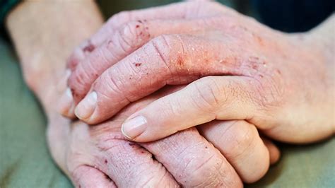 Itchy Palms: Causes, Symptoms, and Treatments