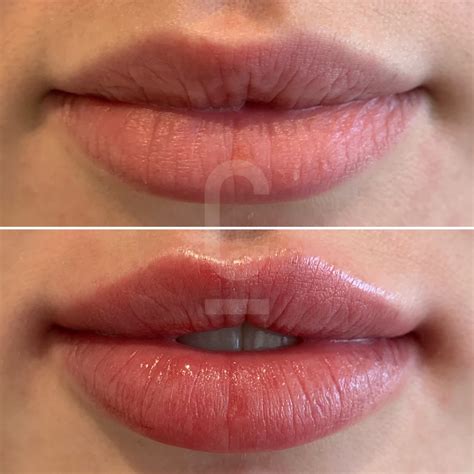 Lip Filler Defined Cupid's Bow at Gary Delariva blog