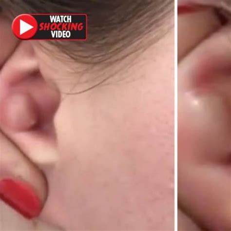 Ear Cysts Popping