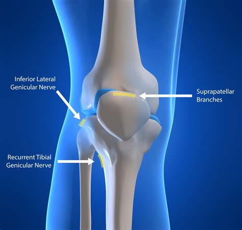 Genicular Neurotomy | Nerve Ablation | Ainsworth Institute