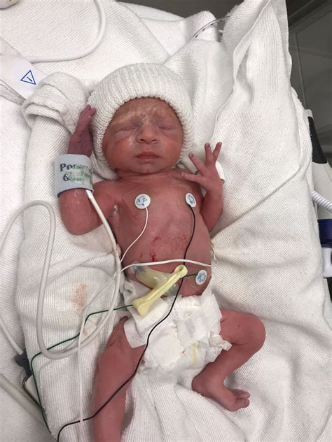 Pictures Of Babies Born At 32 Weeks Pregnant