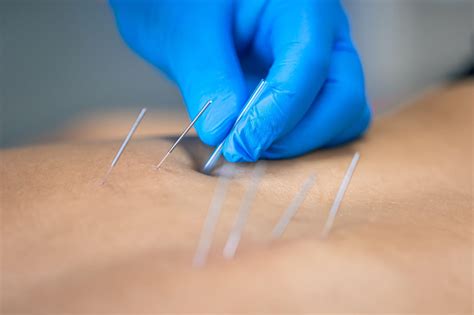 Alleviate Pain with Dry Needling in Chicago, IL