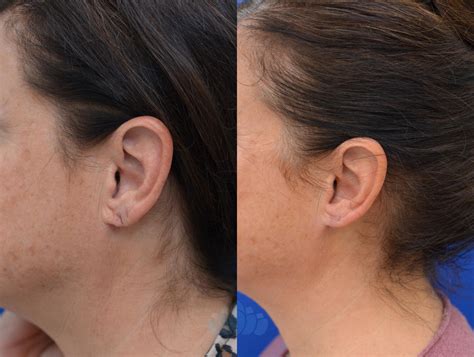 Earlobe Repair Before and After Pictures Case 88 | Charlotte, NC | Dilworth Facial Plastic Surgery