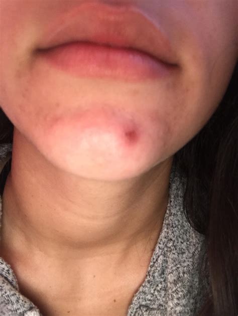 Cystic Acne Chin