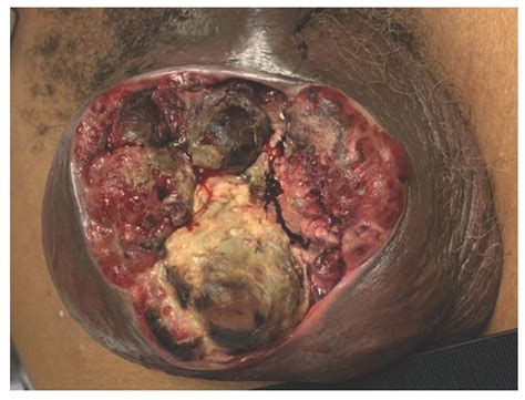 Pure Yolk Sac Tumor of the Testis with Scrotal Invasion in an Adult Male