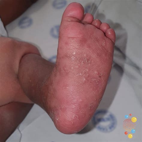 How Long Does Scabies Live On A Surface at Jose Kennedy blog