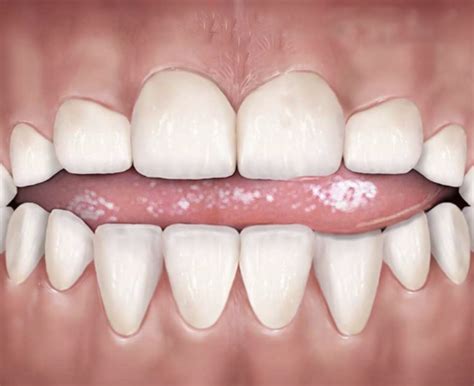 What is Tongue Thrust in Adults: Signs, Affect on Face & Teeth, How to ...