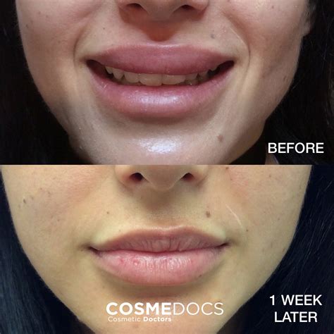 Botox Lip Bruising at Harry Stedman blog