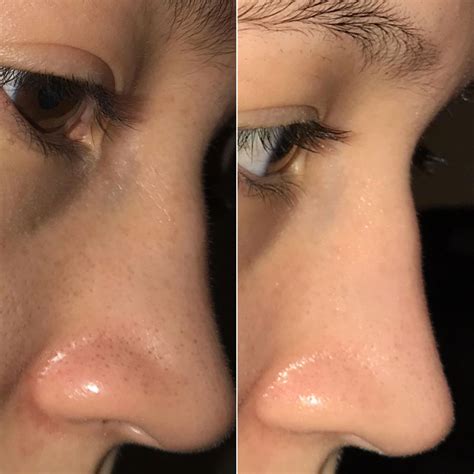 Reddit User's Six-Step Blackhead Removal Routine With Before And After ...