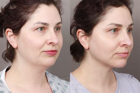 Liposuction & Renuvion Skin Tightening (1.5 Months Post-op) Before & After Gallery - Case: 10908