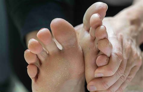 Understanding Pitted Keratolysis: Causes, Symptoms, and Treatment ...